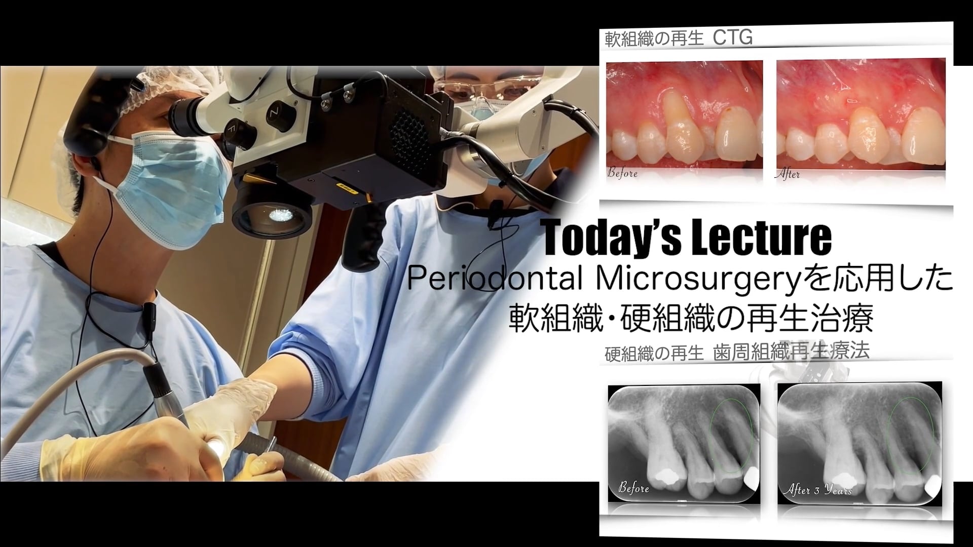 第3回「Periodontal microsurgeryを応用した軟組織・硬組織の再生治療」講師：富塚佳史